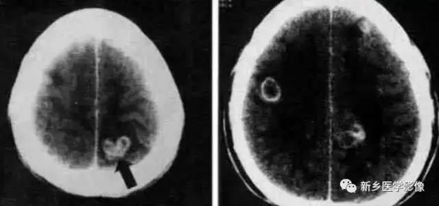 颅内有钙化怎么治疗,34岁脑部有钙化正常吗