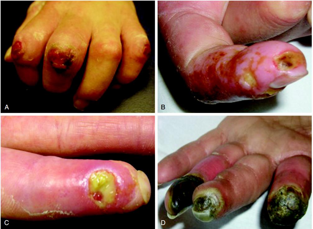 硬皮病是一种什么病,硬皮病由什么造成的