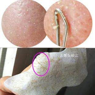 黑头镊子清理过程,专业黑头清理过程