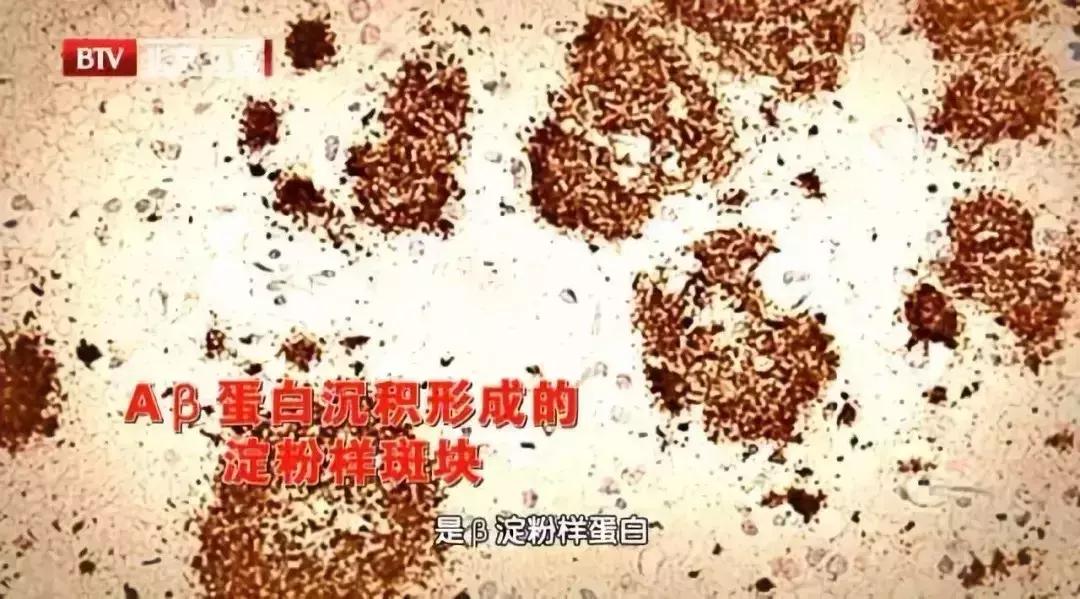 爱忘事吃什么药可以调理,爱忘事记忆力差怎么改善