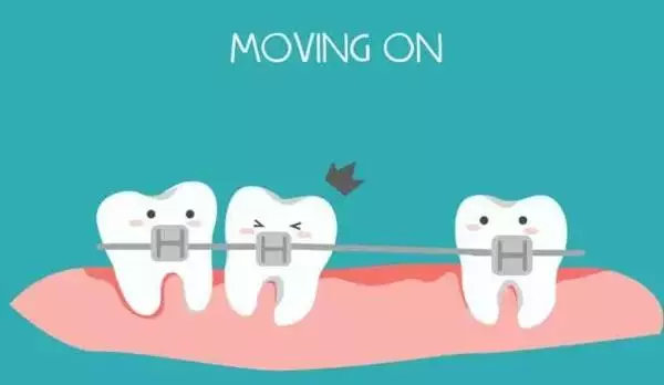 牙齿矫正过程牙套脱落问题,牙齿矫正各种问题以及解决方法