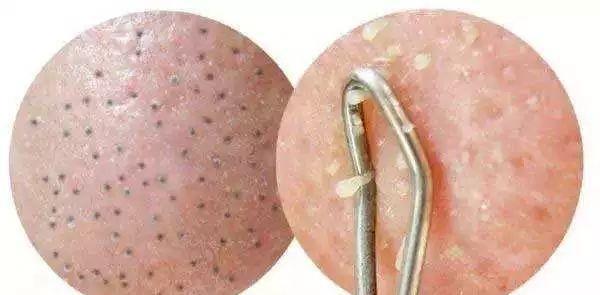 为什么挤黑头伤毛孔,为什么挤黑头时间长了心慌