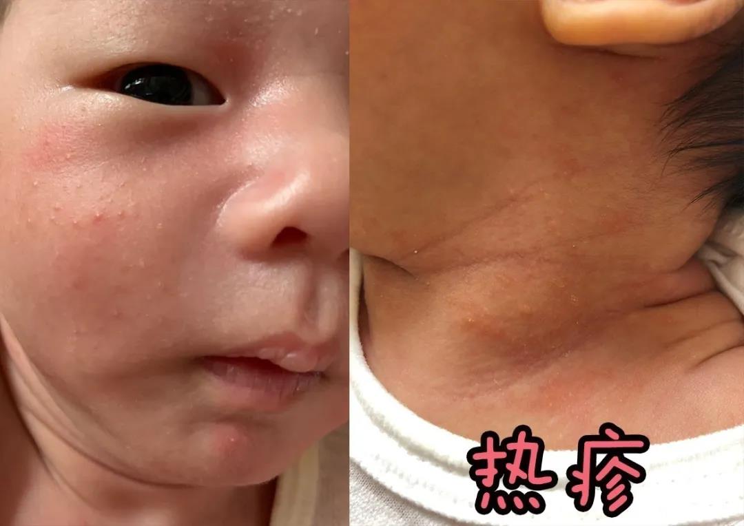 宝宝眼睛周围长湿疹要如何护理,宝宝湿疹怎么护理才能彻底治愈