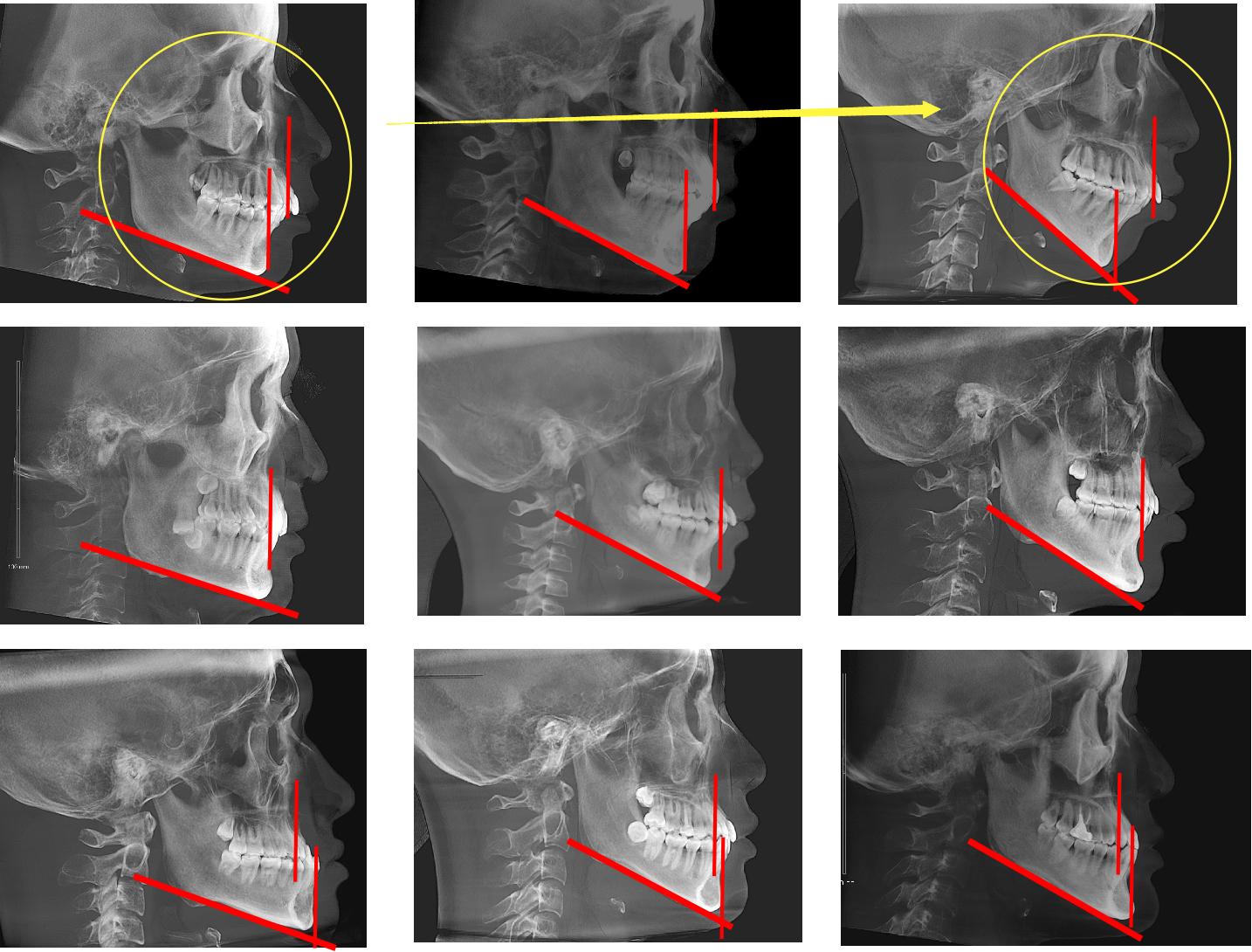 华晨宇的下巴,削下颌骨的华晨宇