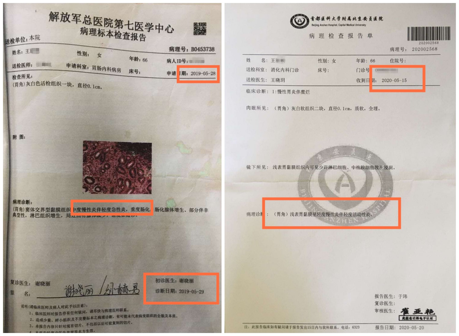 胃炎伴肠上皮化生有多严重？什么程度才算是癌前病变？