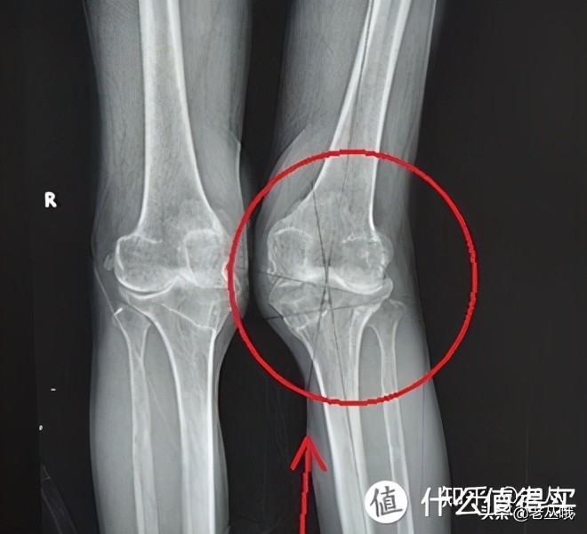 改善x型腿最有效的方法,x型腿的快速矫正方法