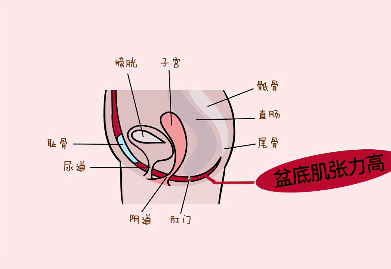 盆底肌一直锻炼会不会比以前好,盆底肌不合格可以做运动吗