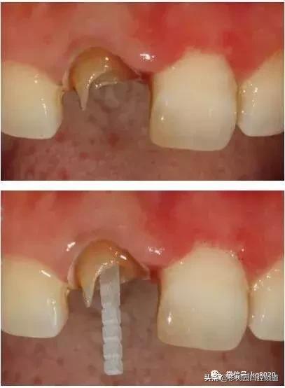 纤维桩的优点和缺点,看完这篇文章就明白了