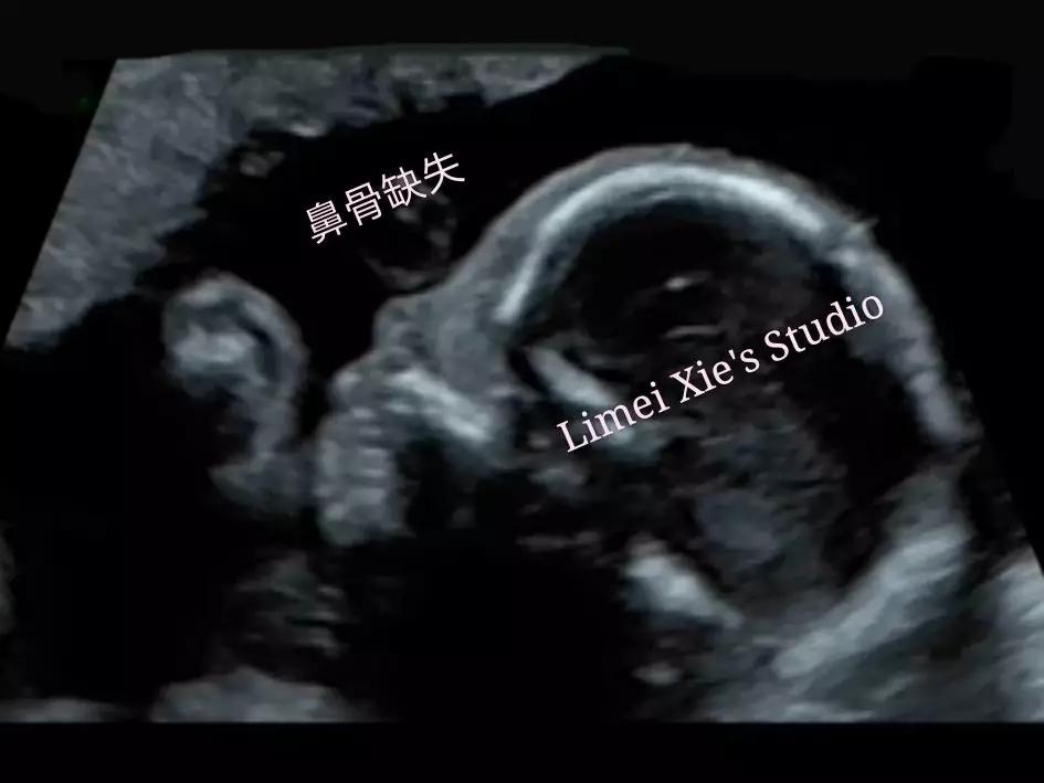 唐氏儿鼻骨是缺失还是发育不良,20周胎儿一侧鼻骨缺失或发育不良