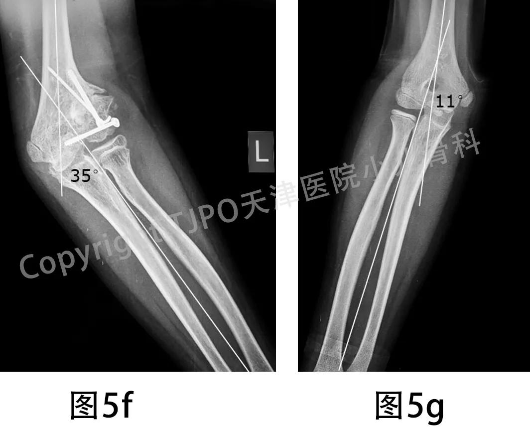肱骨髁上骨折如何预防肘外翻畸形,肱骨髁上骨折外翻畸形原因