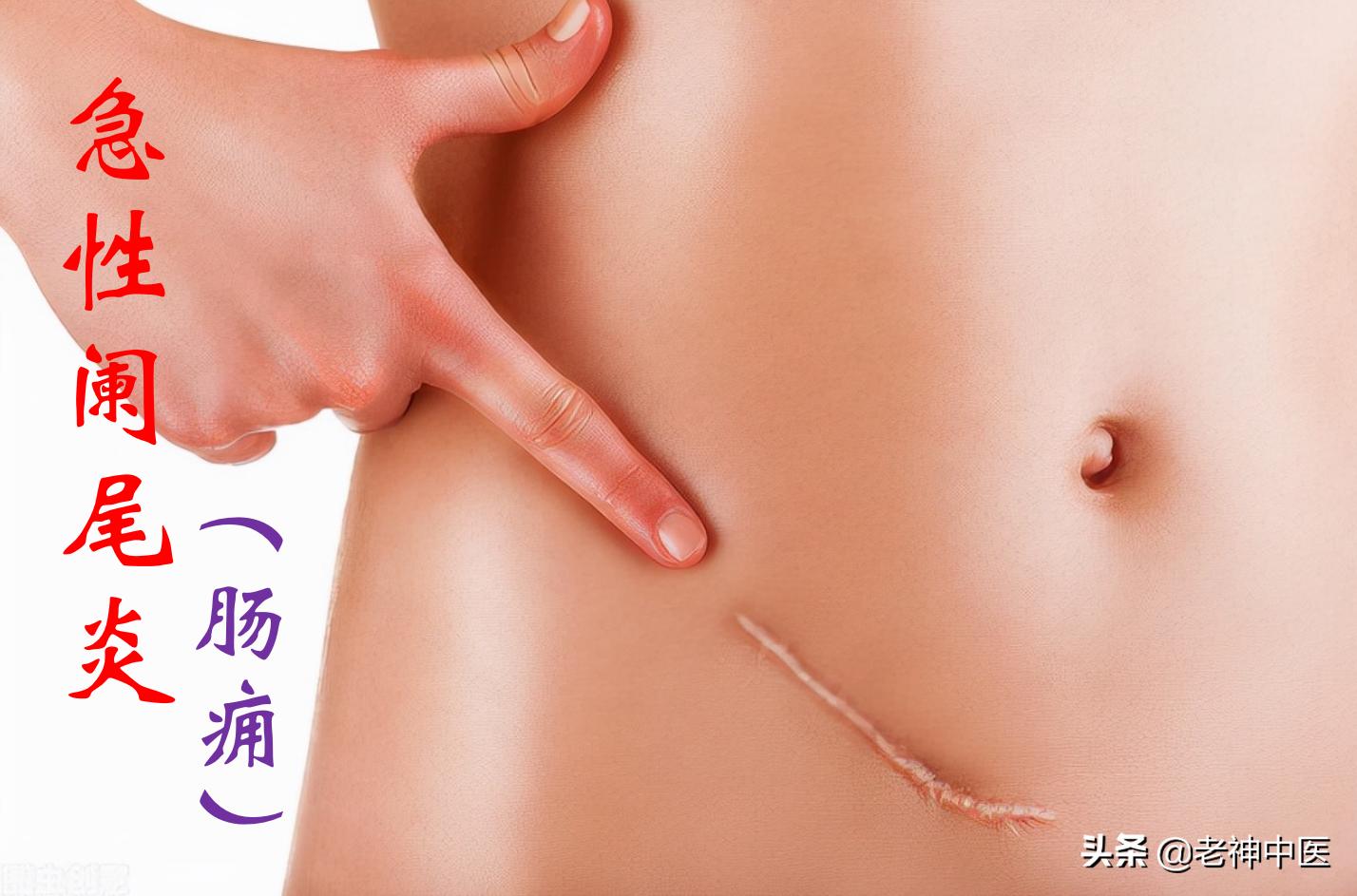 慢性阑尾炎大黄牡丹汤医案,大黄牡丹汤治疗阑尾炎原方