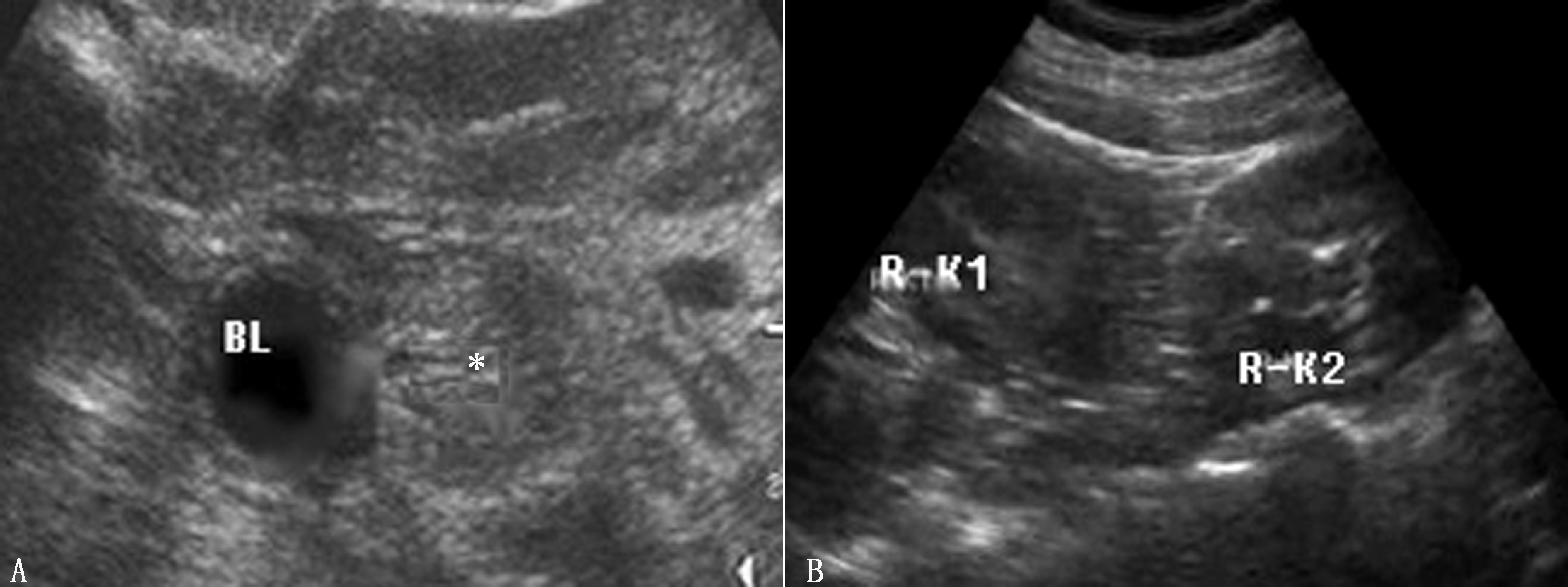 胎儿右肾发育不良是不是属于畸形,胎儿泌尿系统畸形超声表现