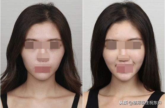 脂肪填充苹果肌多久消肿恢复自然,脂肪填充苹果肌一边多久吸收正常