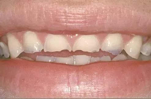 牙釉质很脆是怎么回事,牙釉质为什么会脱落