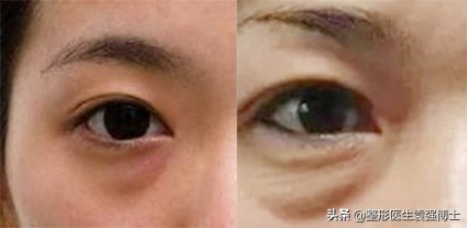 做眼袋都需要问医生什么问题,做手术前要咨询医生哪些问题