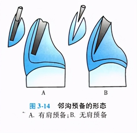 牙齿缺损修复去哪家牙科医院,牙科门牙缺损修复照片