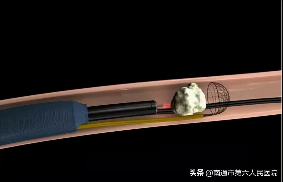 肾结石体外震波碎石治疗费用多少,肾结石在什么位置不能用体外碎石