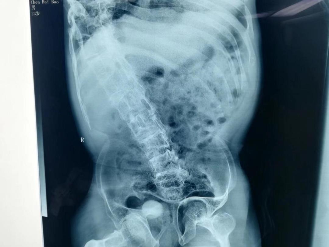 经皮肾镜切开取石术,超微可视经皮肾镜碎石取石术危险