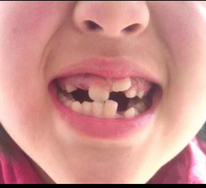 孩子换牙后牙齿变化图,孩子乳牙很好换牙都歪是怎么回事