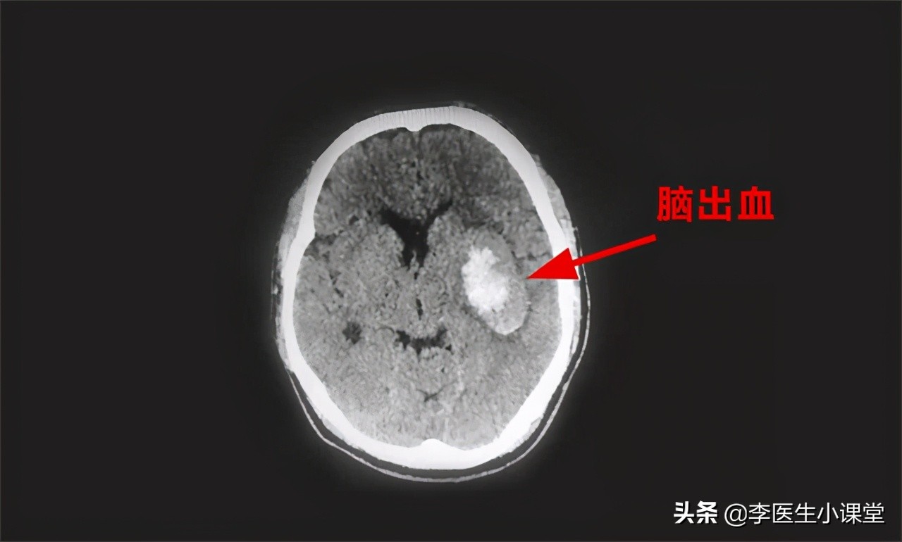 高血压引发脑出血的最佳急救办法,家人突发脑出血医生教你如何急救