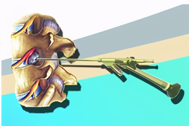 颈椎椎管狭窄手术成功率,2020年胸椎管狭窄手术成功率