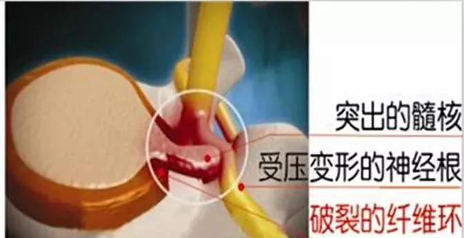 25岁得了腰椎间盘突出4年了,50岁腰椎间盘突出腰疼