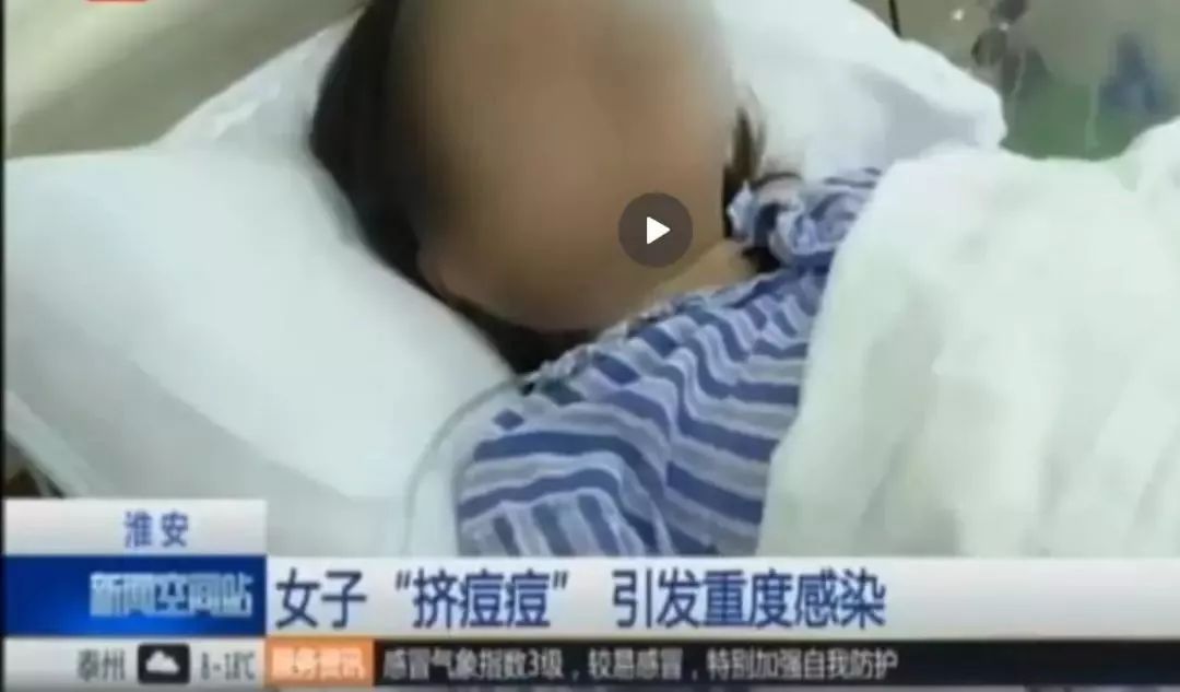 挤痘进了ICU，连下两次病危通知？这痘痘到底还能不能挤！