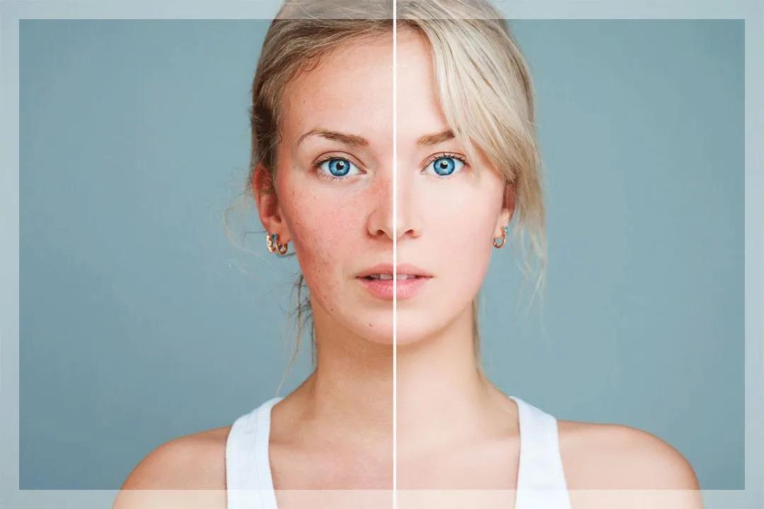 干皮换季长痘起皮,皮肤干燥起皮泛红长痘修复屏障