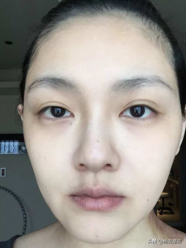 医美都有哪些项目改善皮肤,毛孔粗大的护肤和医美思路有哪些