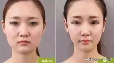 除了肉毒素还有什么能去皱,肉毒素去皱适合年龄