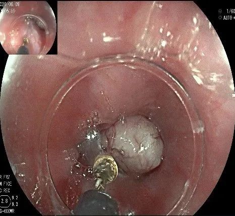 贲门隆起性病变影像,贲门溃疡隆起性病变