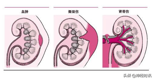 肾脏输尿管膀胱前列腺结构,肾输尿管膀胱解剖示意图