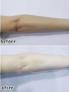 胳膊肘关节处黑怎么美白,手指关节黑怎么美白