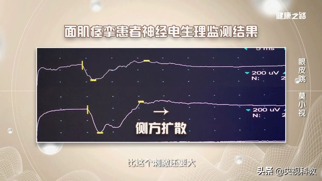 眼皮持续跳警惕面肌痉挛青光眼,眼皮跳可能是面肌痉挛惹的祸