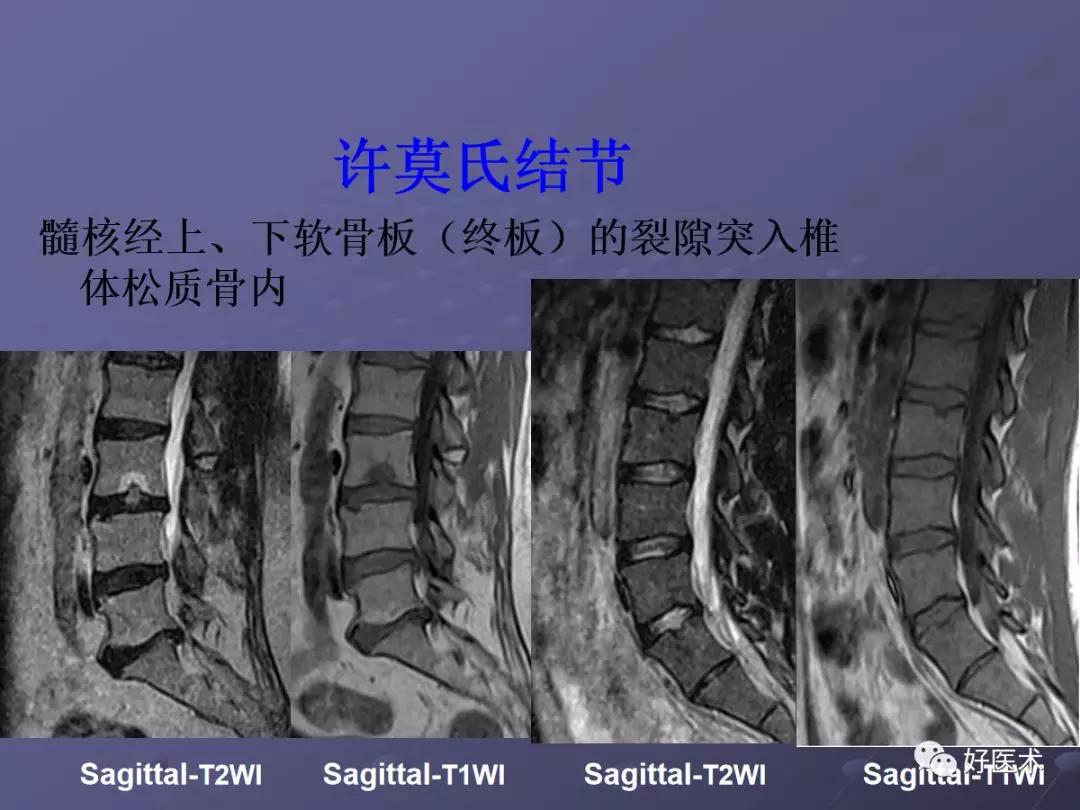 脊柱mri有哪些特点,乳腺疾病的mri诊断及鉴别