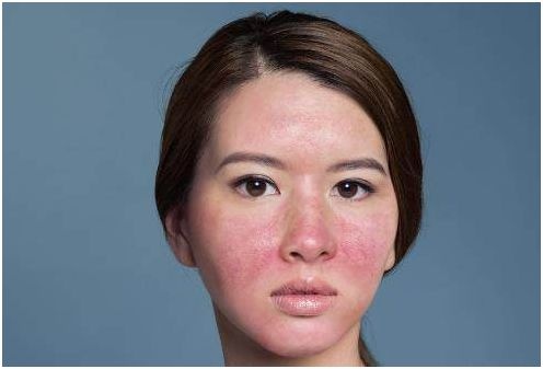 痤疮贴有用吗,玫瑰痤疮的最佳治疗方法