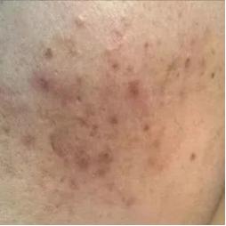 抖音别来无恙,痘印走开对付痘印的正确方法