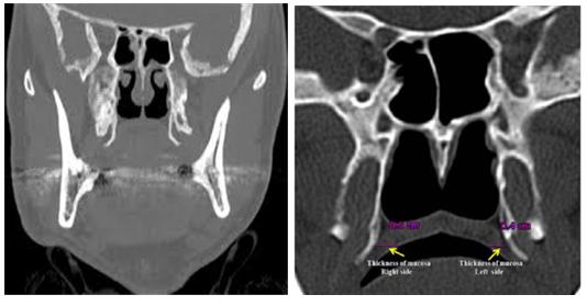 翼钩综合症是什么病能治愈吗,颌面疼痛是怎么回事