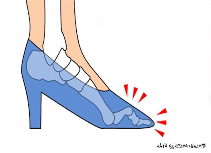 引起足部疼痛的原因,足底筋膜炎疼痛位置图
