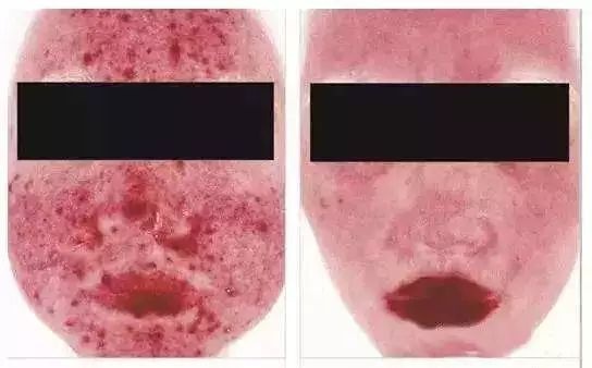 实用帖:玫瑰*疮痤**不可怕,可怕的是你不够重视它