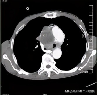 常州二院甲状腺消融术,常州二院微创手术怎么样