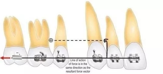 矫正牙齿打支抗钉亲身经历,矫正支抗钉一般打哪个位置