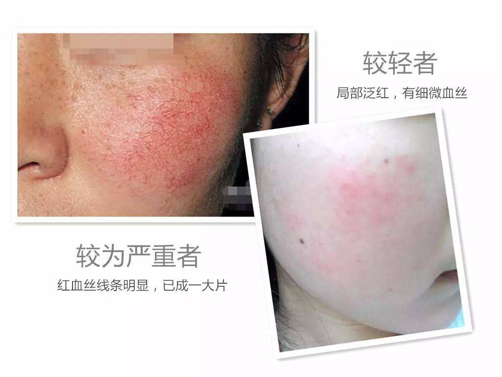 脸上有红血丝平时应该怎么护肤呢,脸上有红血丝需要怎么护肤