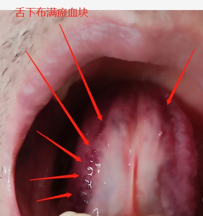 手指麻木不一定是颈椎病