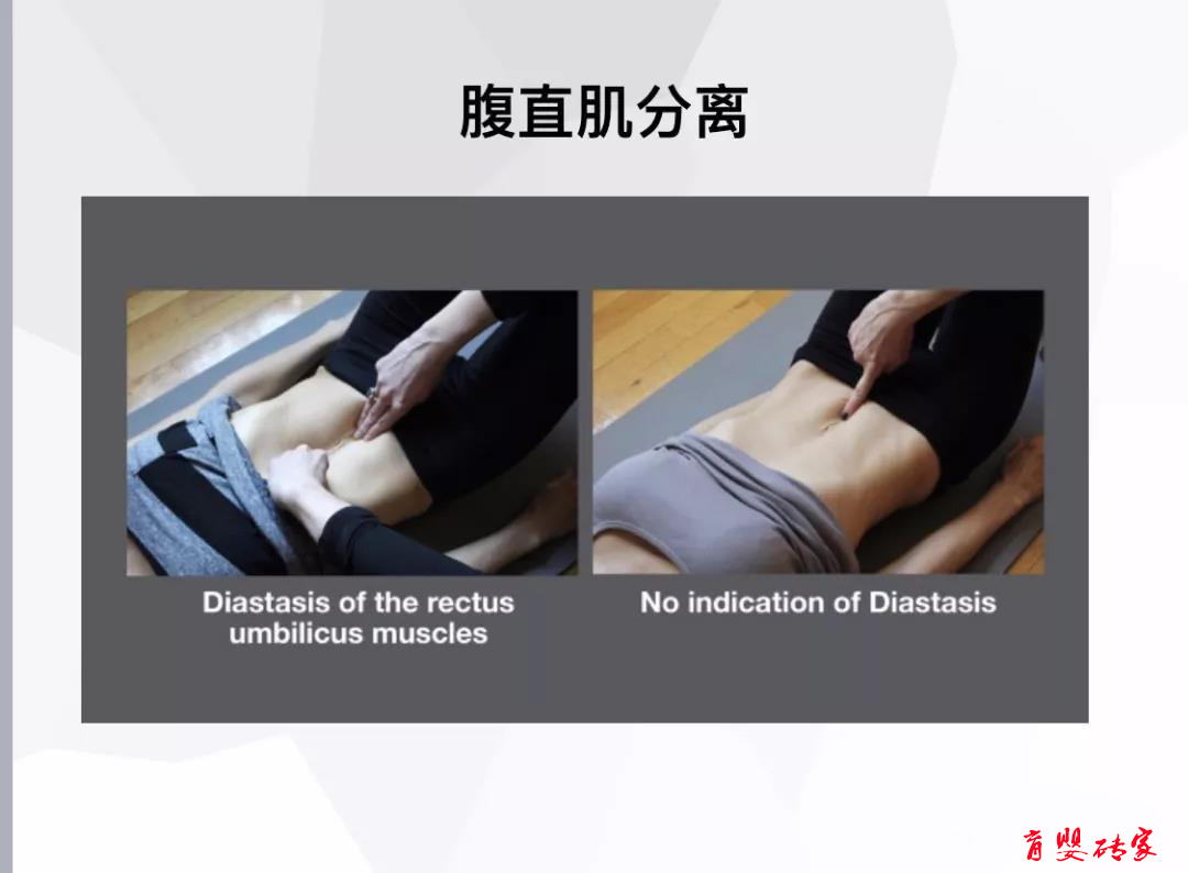 孕妇怎么避免腹直肌分离,孕妇腹直肌分离自测