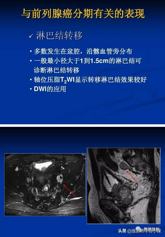 前列腺磁共振影像解剖,前列腺mri正常诊断报告模板