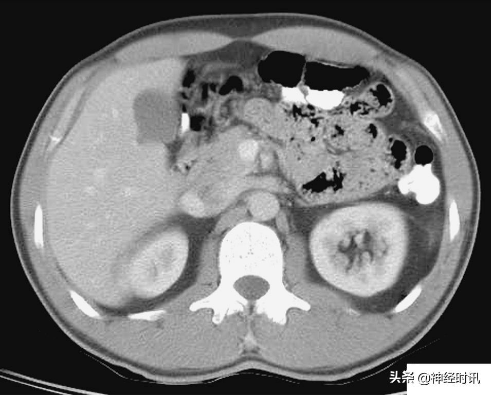 肾脏输尿管膀胱前列腺结构,肾输尿管膀胱解剖示意图