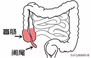阑尾炎脓肿保守治疗后必须手术吗,阑尾炎错过手术时机保守治疗化脓