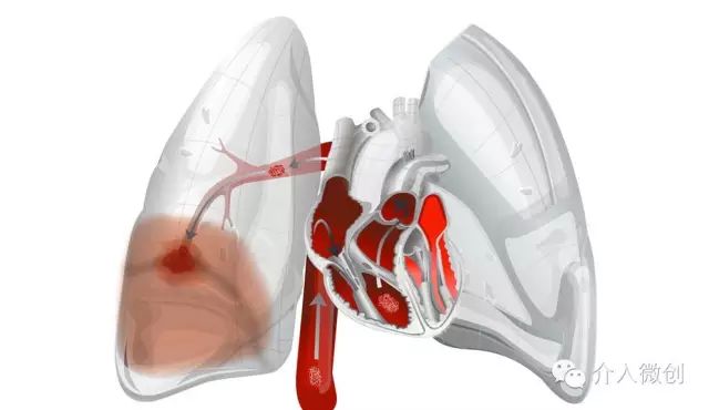 急性肺栓塞的中医操作,肺栓塞微创介入取栓