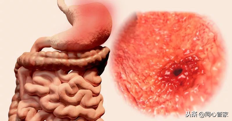 阿司匹林引起肠胃不适怎么办,吃阿司匹林出现了副作用怎么办